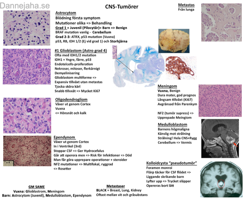 CNS-Tumörer sammanfattning