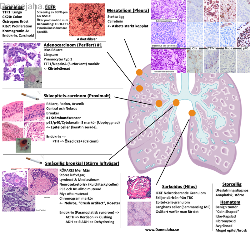 Lungcancer sammanfattning