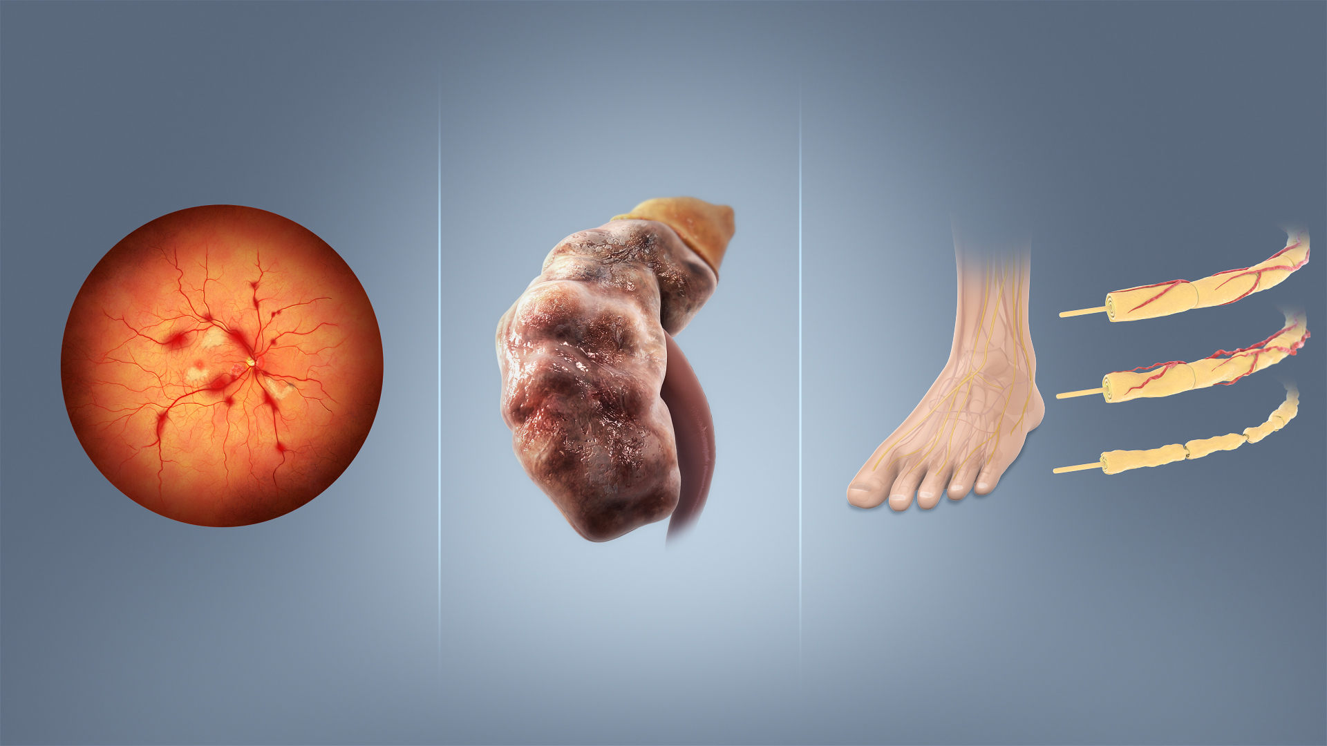 Illustration av tre mikrovaskulära diabeteskomplikationer: ögonbotten vid retinopati, njure vid nefropati och fot med skadade nerver vid neuropati.