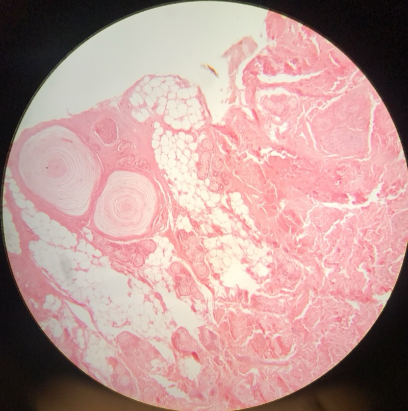 Hud med Vater Paccinis - bild 5