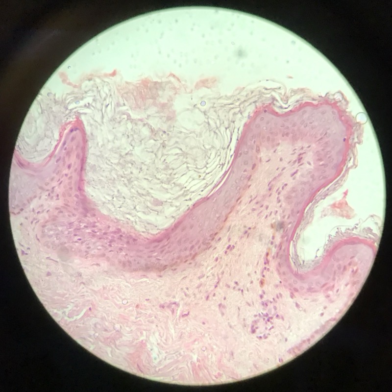 Hud pigmenterad