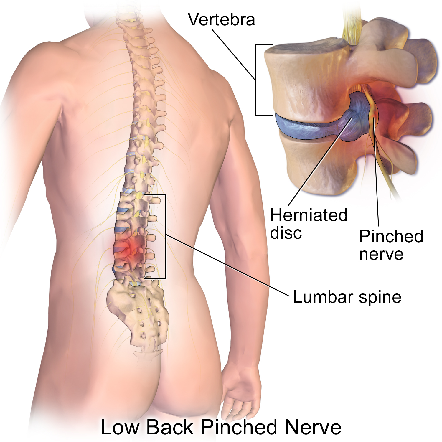Diagram av ett lumbalt diskbråck där nucleus pulposus tränger ut genom annulus fibrosus och trycker mot en nervrot.