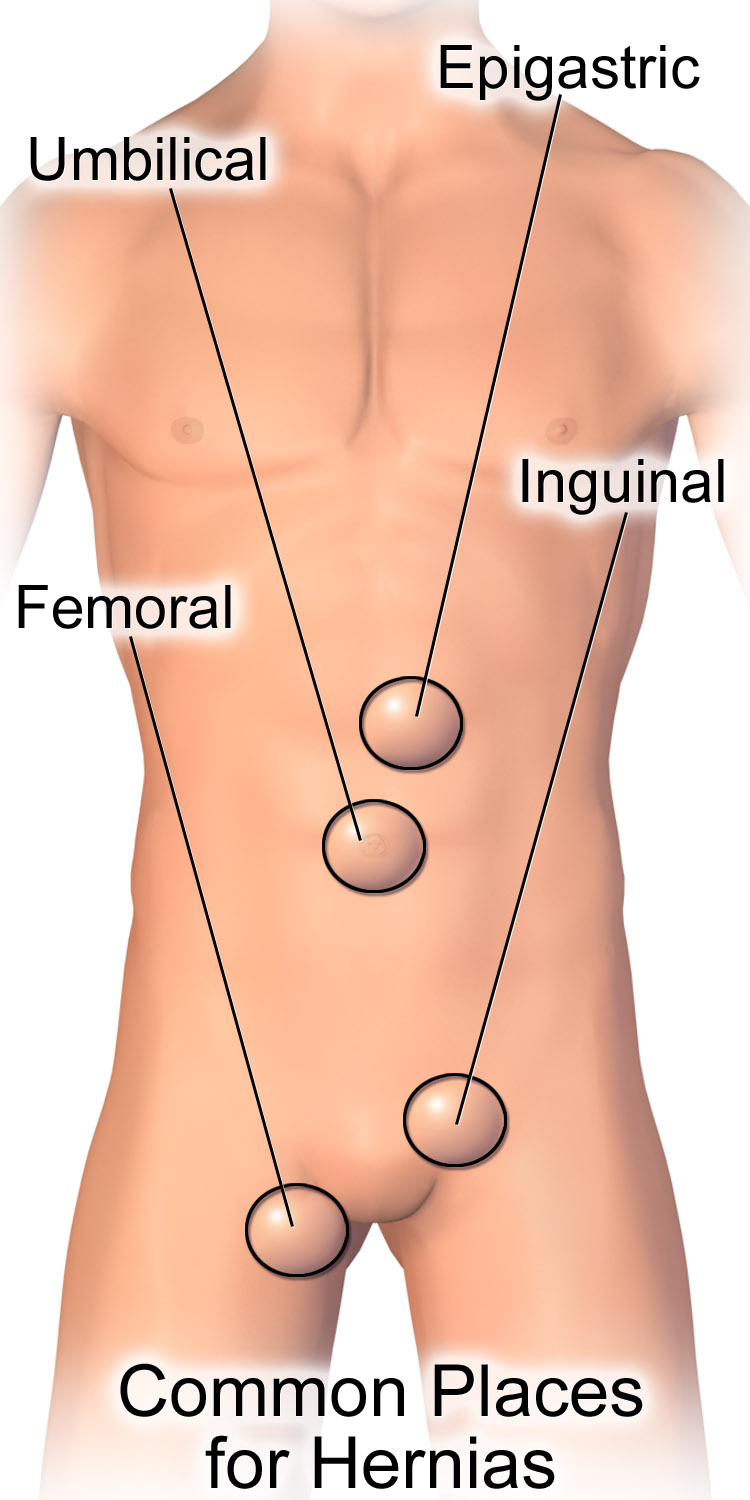 Diagram över vanliga lokalisationer för bukväggsbråck: ljumskbråck, femoralbråck, navelbråck och ärrbråck.
