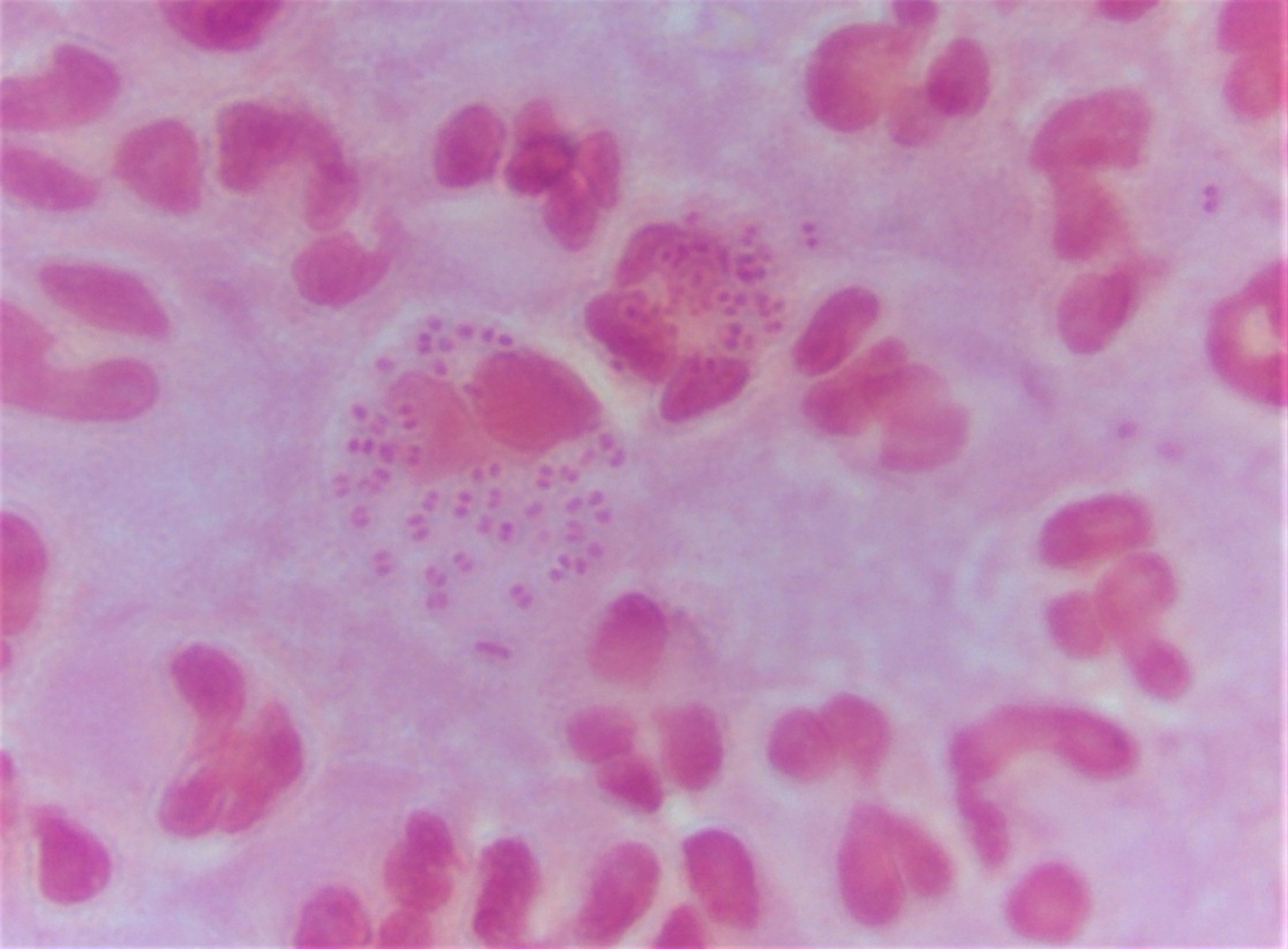 Gramfärgning av uretrasekret vid gonorré: gramnegativa diplokocker (Neisseria gonorrhoeae) ligger i par inuti en neutrofil granulocyt tillsammans med rikligt med vita blodkroppar.