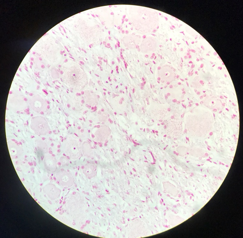 Spinalt Ganglion - bild 1