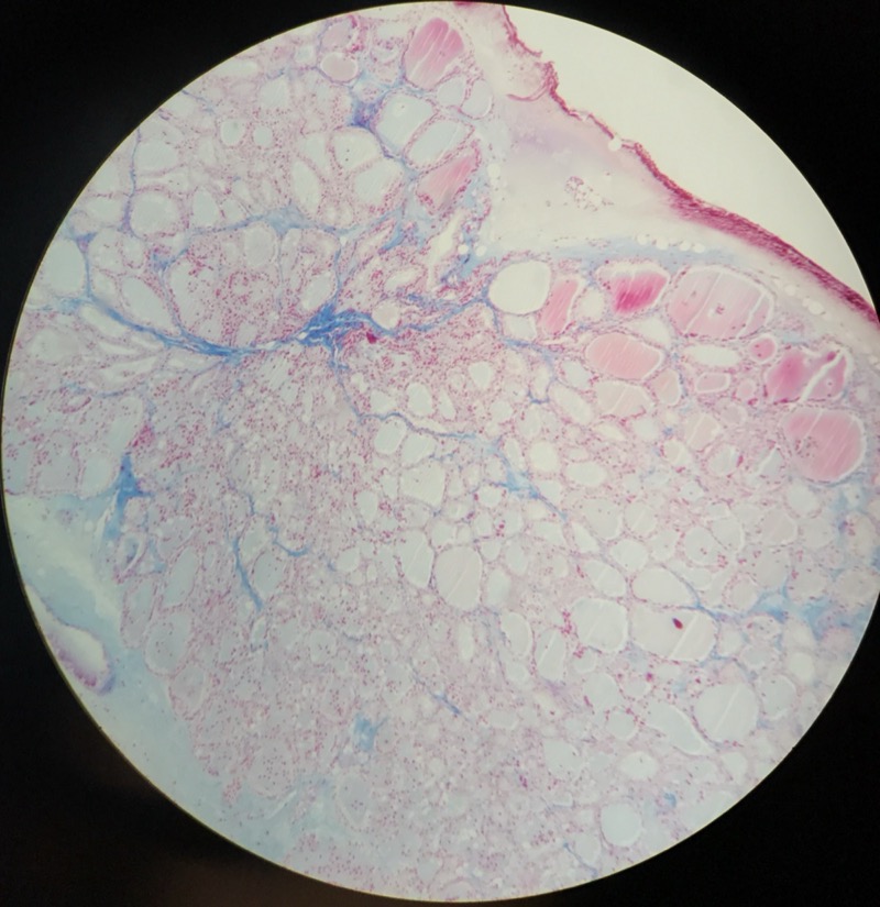 Thyroidea - bild 3