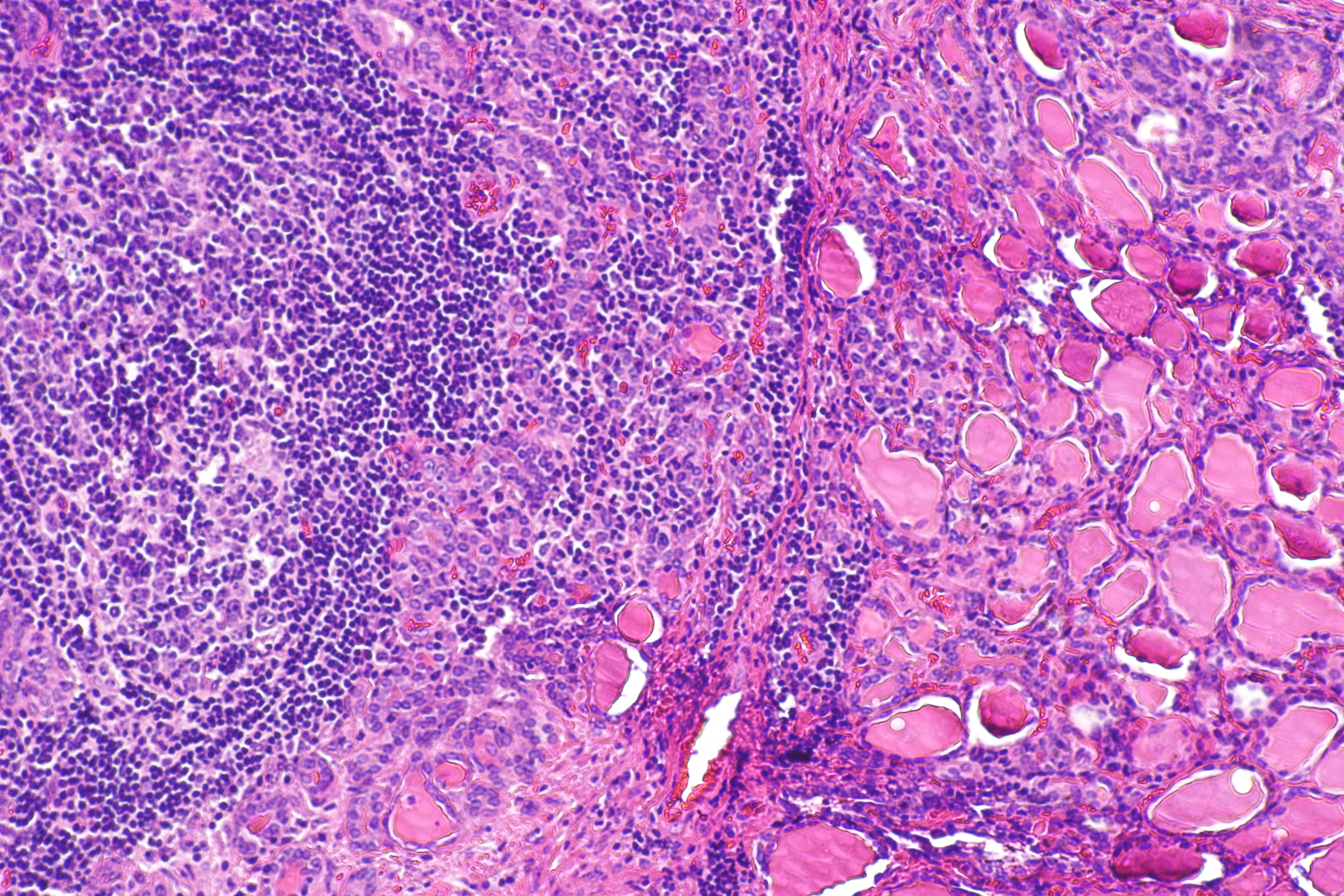 Mikroskopisk bild av sköldkörtel vid Hashimotos tyreoidit med tät lymfocytinfiltration, lymfoida germinalcentra och atrofiska folliklar.