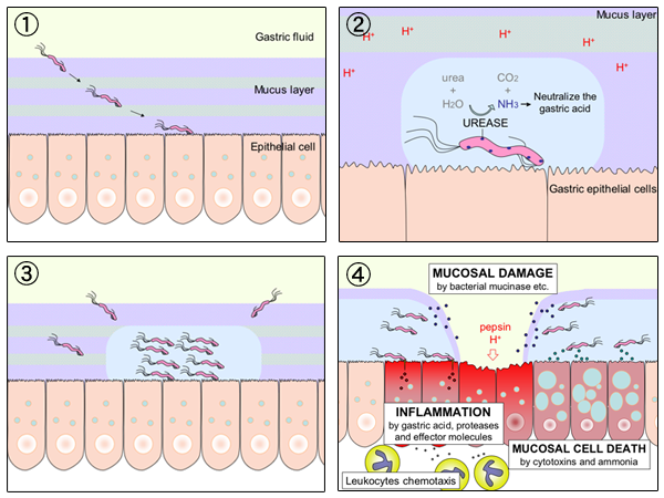 Diagram över hur Helicobacter pylori koloniserar magslemhinnan, producerar ureas och skadar epitelet vilket leder till sårbildning.