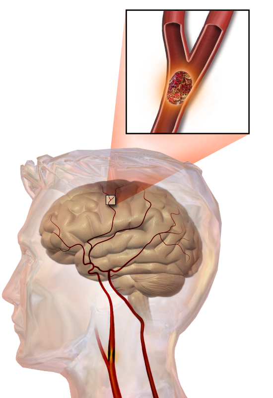 Illustration av stroke: en propp som blockerar en hjärnartär och stoppar blodflödet till nedströms hjärnvävnad.