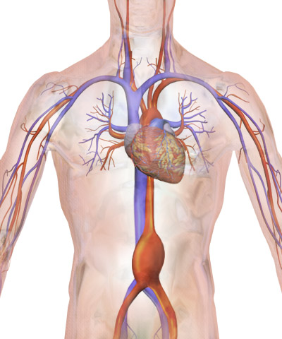 Diagram av bukaortaaneurysm som visar en lokal vidgning av aortas vägg nedanför njurartärerna, jämfört med en normal aorta.