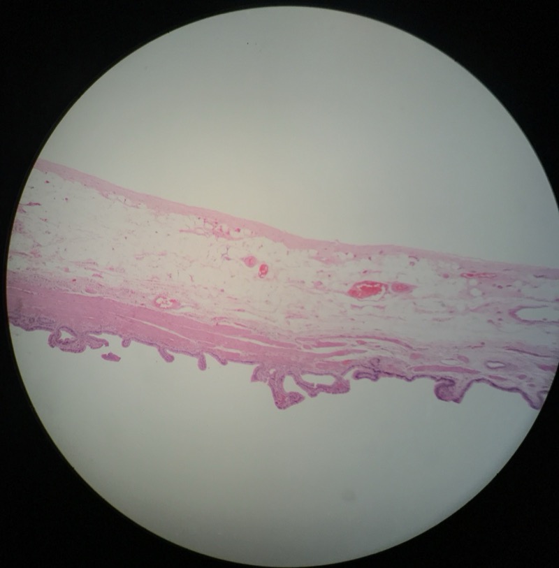 Gallblåsa (Vesica Fellea) - bild 1