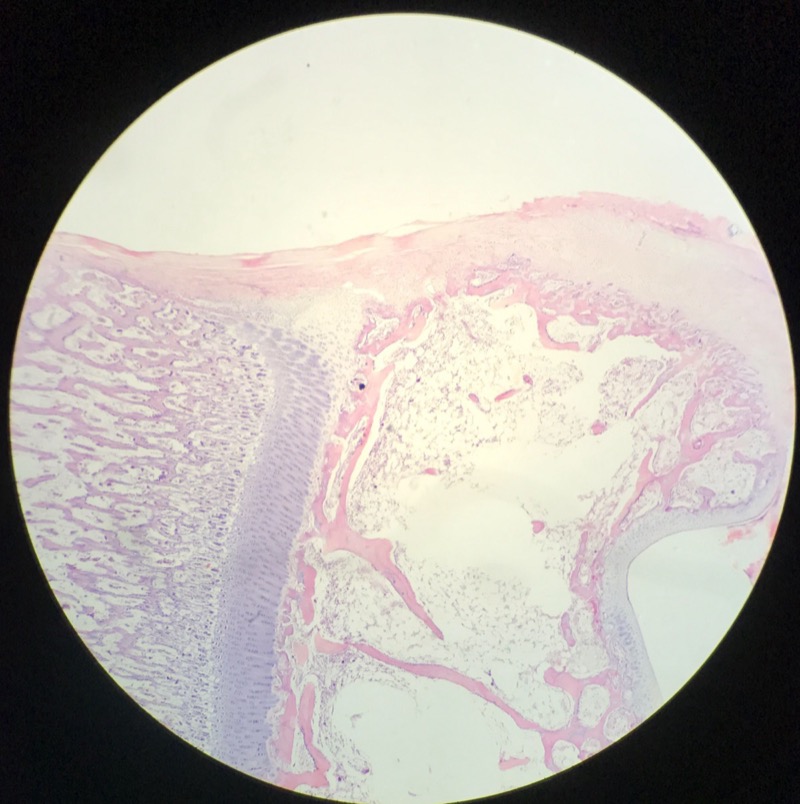 Indirekt benbildning Tibia/Radius - bild 2