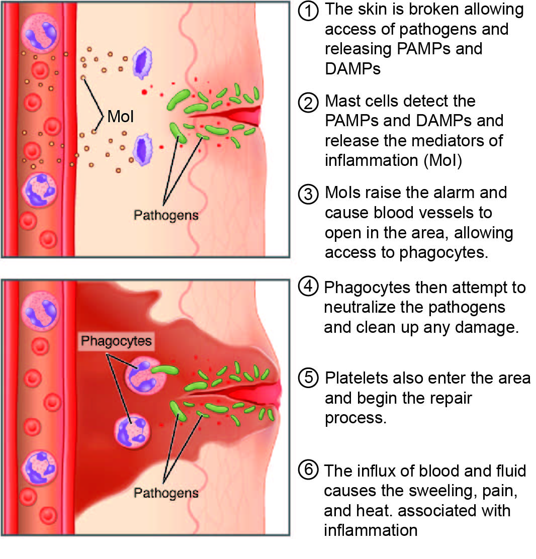 Numrerat diagram över den akuta inflammationsprocessen i sex steg: vävnadsskada släpper in patogener, mastceller frisätter mediatorer, kärlen vidgas, fagocyter och trombocyter rekryteras och vätskeinflödet ger svullnad, smärta och värme.