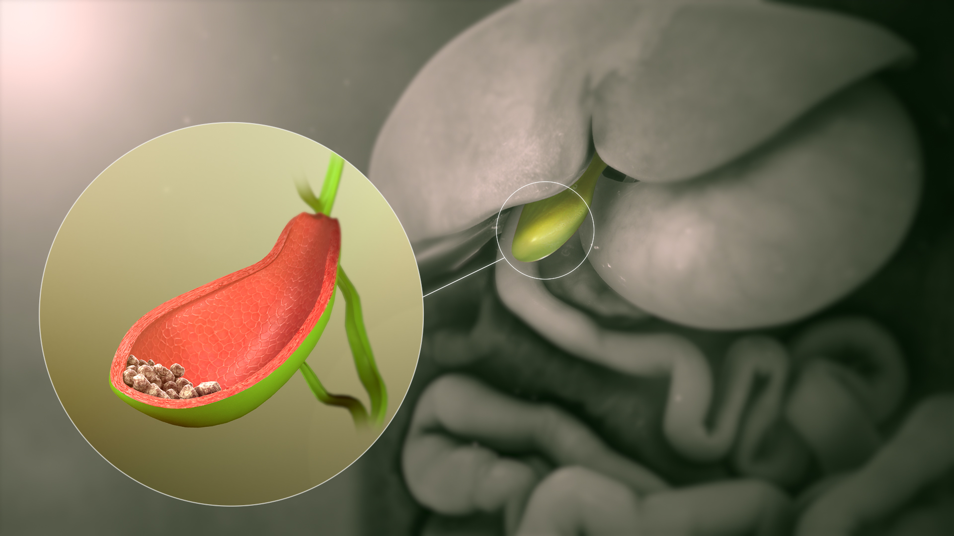 Illustration av en gallblåsa i genomskärning med multipla gallstenar i lumen samt en sten som fastnat i ductus cysticus.