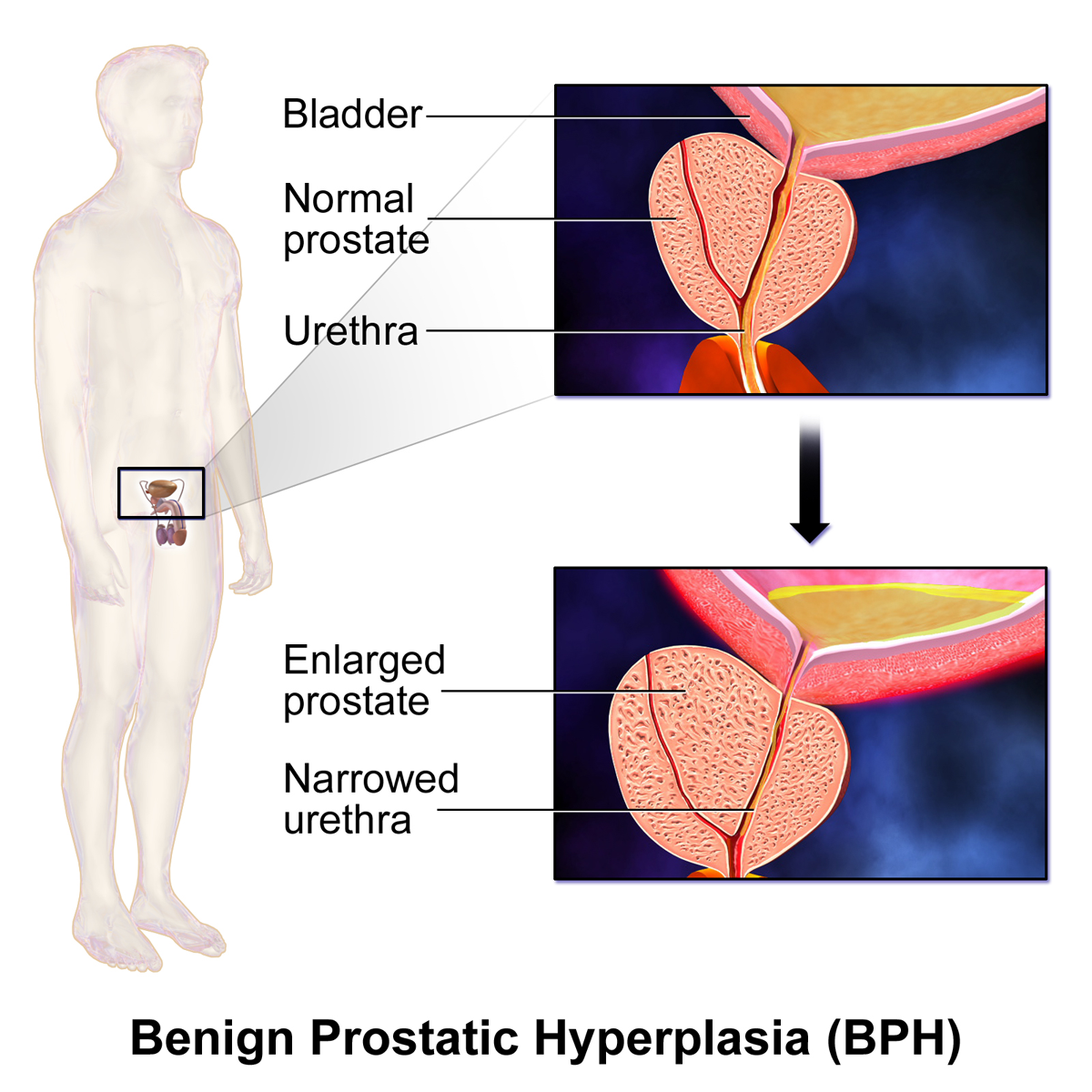 Jämförelse mellan normal prostata och förstorad prostata vid benign prostatahyperplasi, där den förstorade körteln trycker ihop urinröret och försvårar urinflödet.