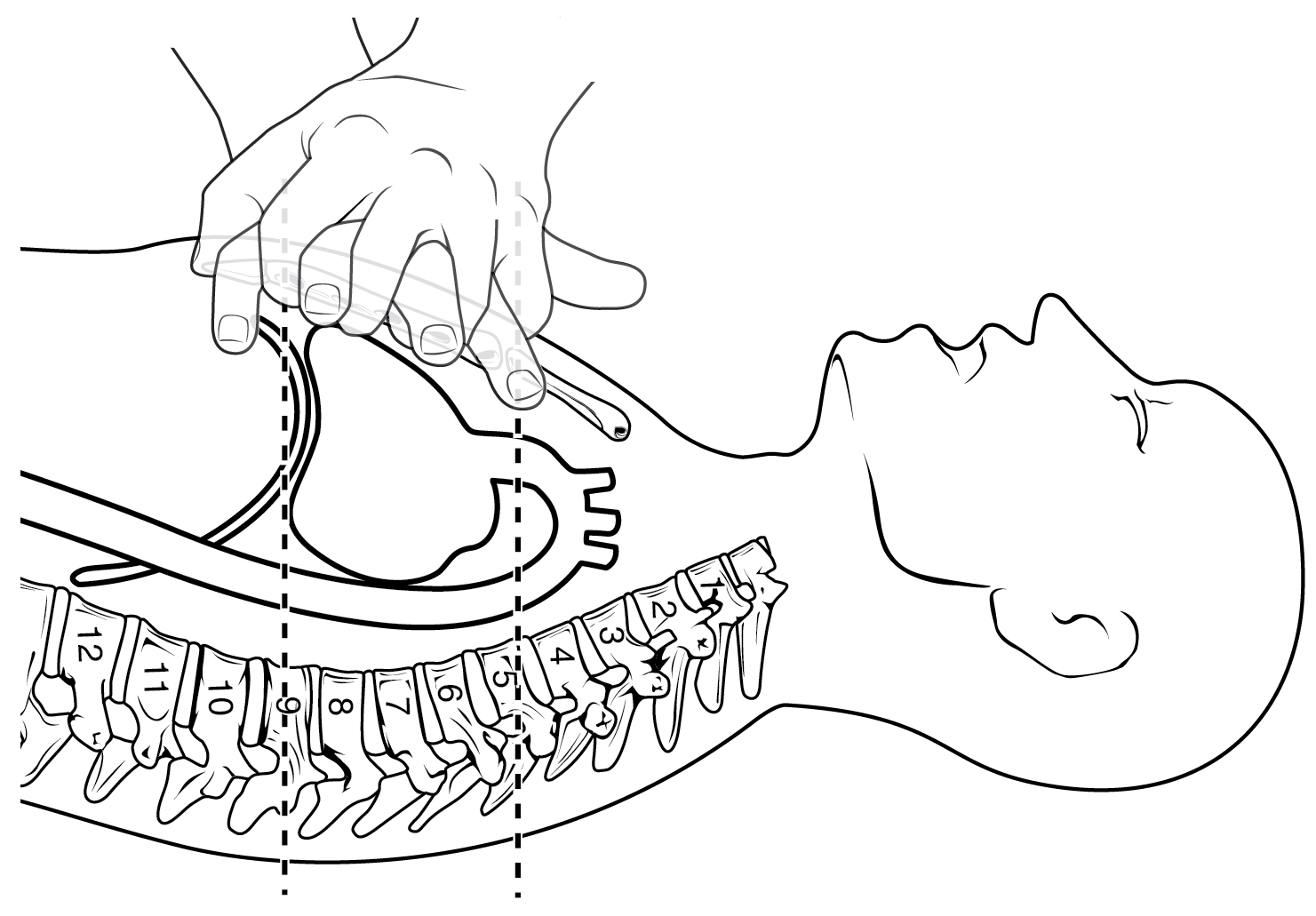 Anatomisk illustration av bröstkompressioner: händerna placerade mitt på bröstbenet medan kompressionen pressar ner sternum och komprimerar hjärtat mot ryggraden.