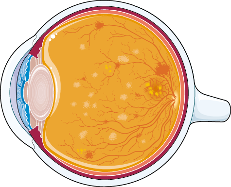 Genomskärning av ett öga med diabetesretinopati: mikroaneurysm, blödningar och exsudat i näthinnan.