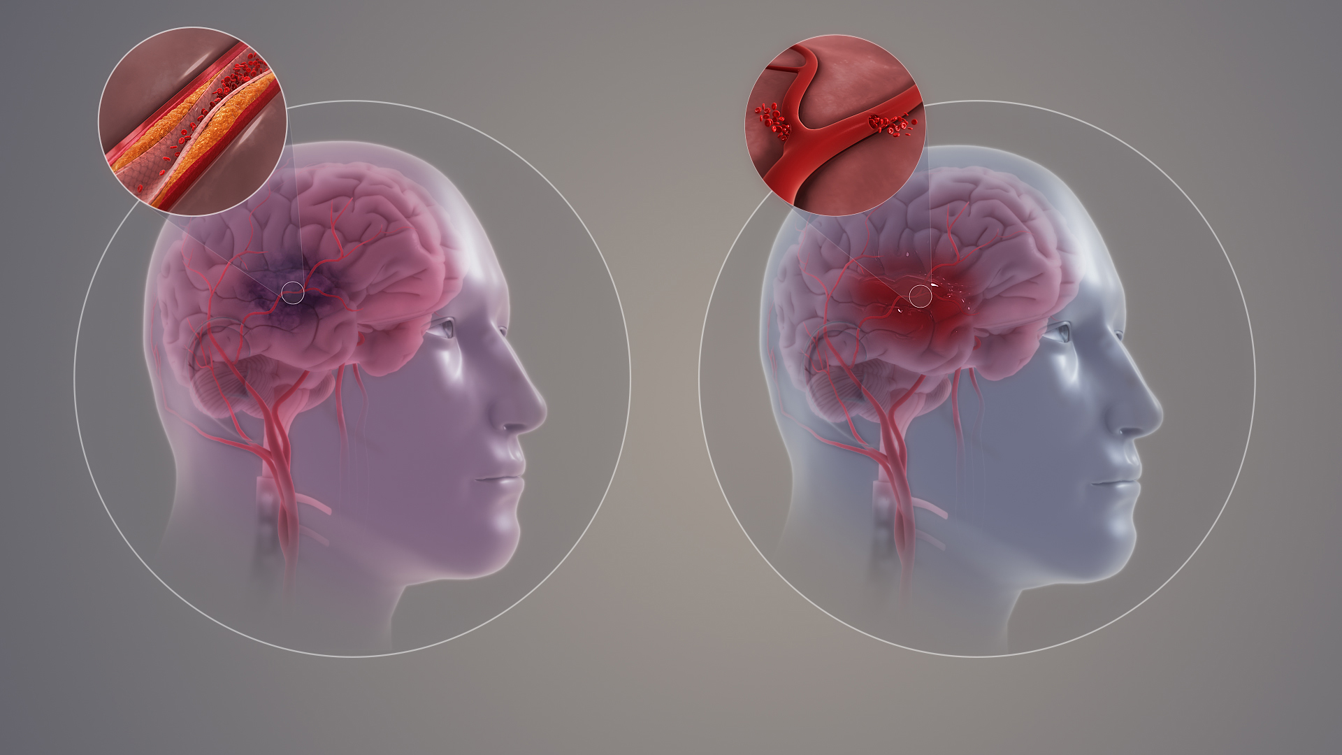 Jämförelse av ischemisk stroke, där en propp stoppar blodflödet, och hemorragisk stroke, där ett kärl brister och blod läcker ut i hjärnvävnaden.