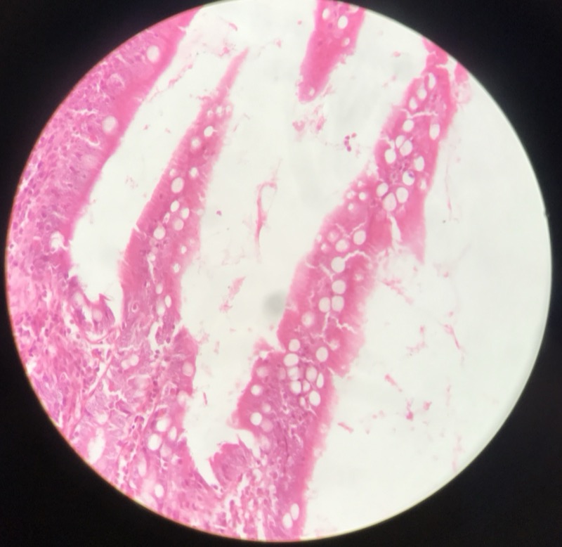 Ileum - bild 3