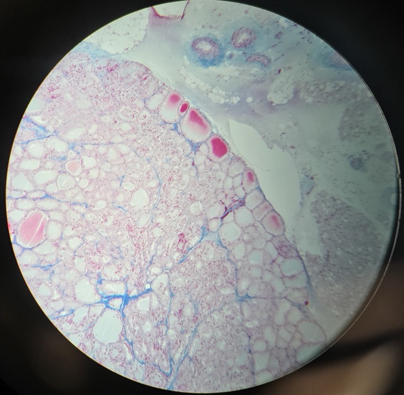 Thyroidea - bild 4