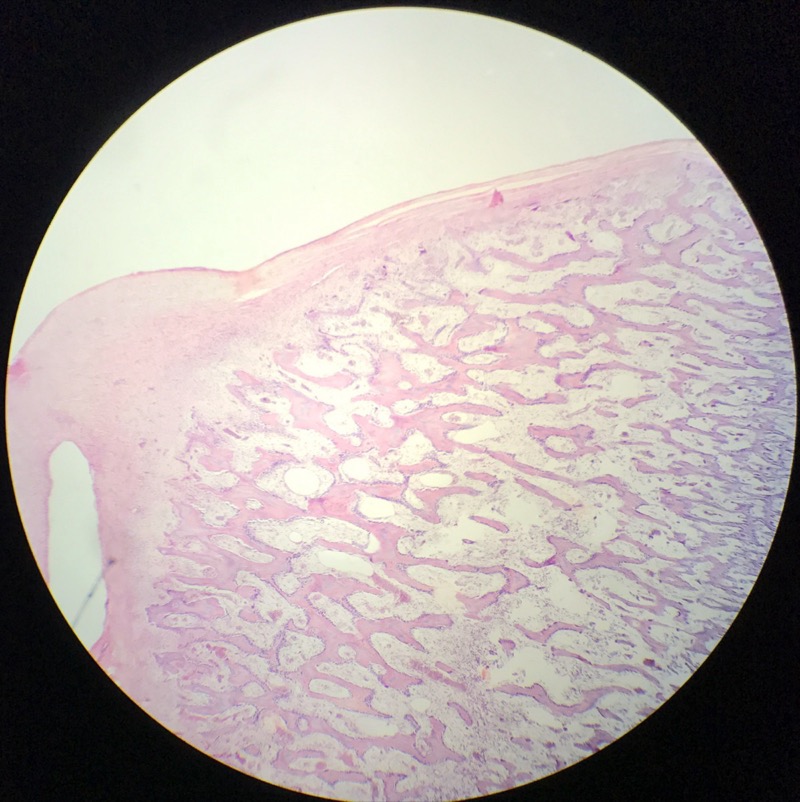 Indirekt benbildning Tibia/Radius - bild 3
