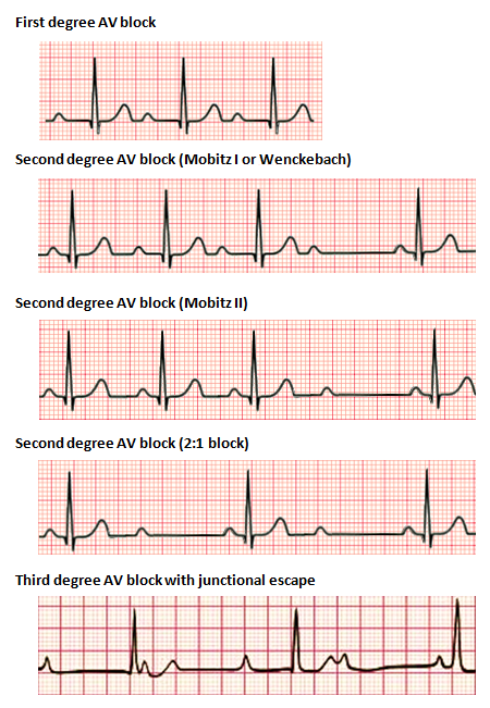 EKG-diagram över de olika graderna av AV-block: grad I med förlängt PQ, grad II med periodvis uteblivna QRS-komplex och grad III med total AV-dissociation.