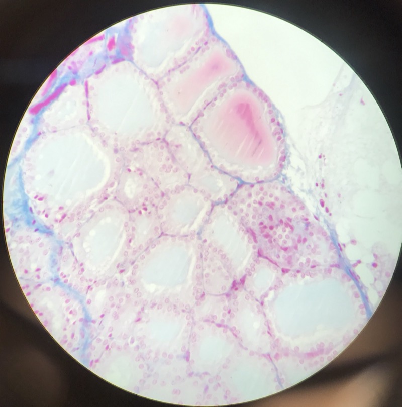 Thyroidea - bild 5