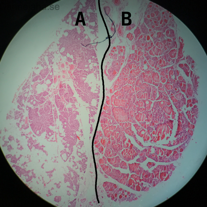 Parathyroidea med thyroidea
