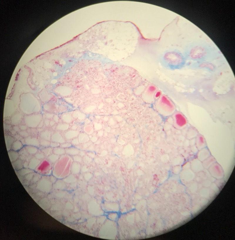 Thyroidea - bild 2