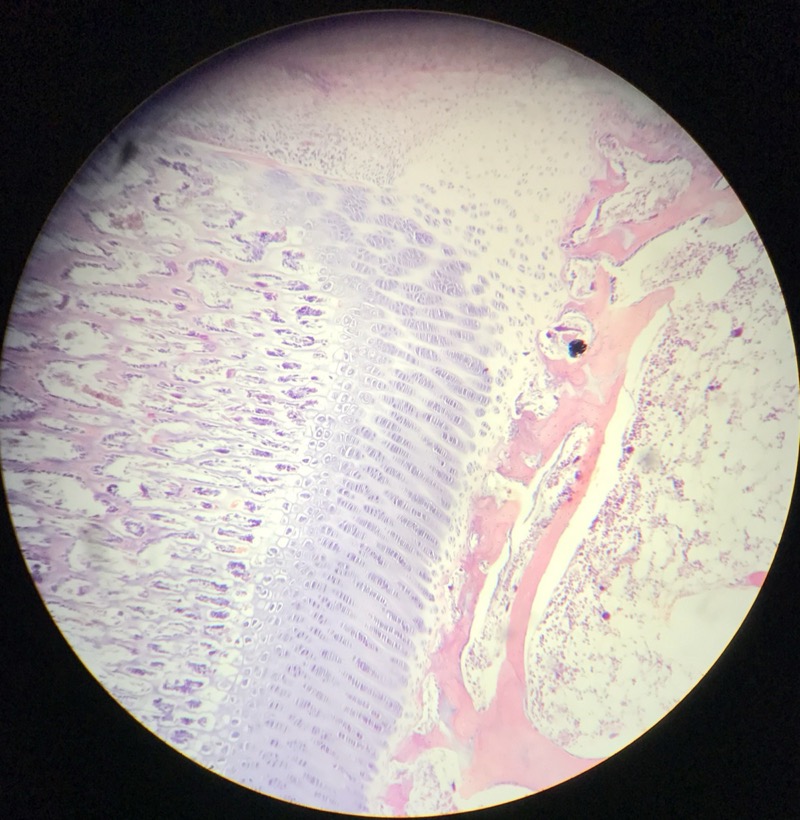 Indirekt benbildning Tibia/Radius - bild 1